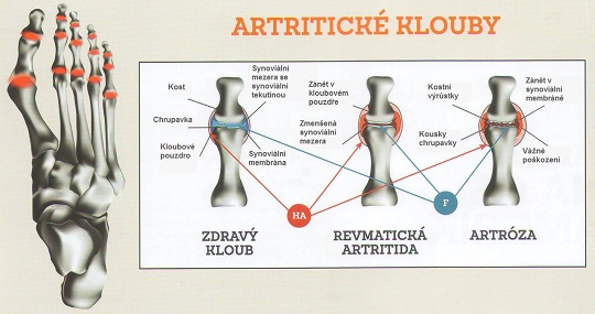 artritické klouby